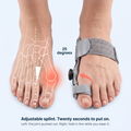 The joint pushed out, and the same foot with the BunionCore splint holding the toe in line